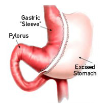 Sleeve Gastrectomy